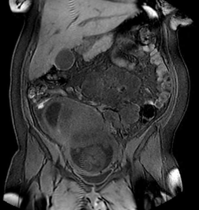 Colon adenocarcinoma with Krukenberg tumors, advanced pregnancy (Radiopaedia 67279-76645 E 37).jpg