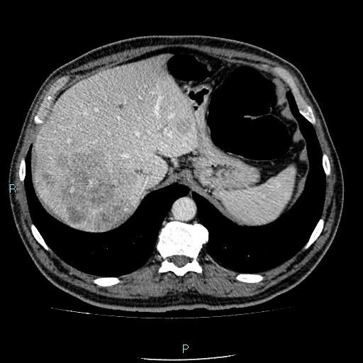Colon adenocarcinoma with calcific liver metastasis (Radiopaedia 55745-62300 B 6).jpg