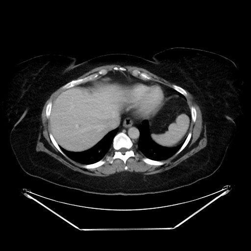File:Colonic intussusception due to adenocarcinoma (Radiopaedia 86828-102987 A 23).jpg