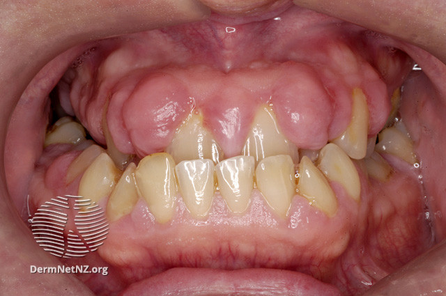 File:Gum hypertrophy due to ciclosporin (DermNet NZ treatments-csa-gums).jpg