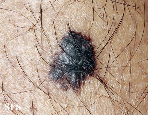 File:Melanoma (Dermatology Atlas 80).jpg