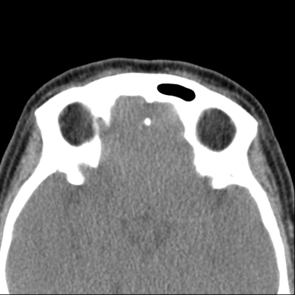 Nasolabial cyst (Radiopaedia 33987-35205 Axial non-contrast 44).jpg