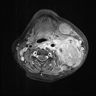 Nasopharyngeal carcinoma- T4,N3b (Radiopaedia 59376-67000 Axial T1 C+ fat sat 47).jpg