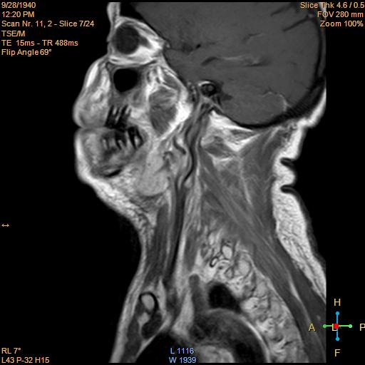 File:Nasopharyngeal carcinoma (Radiopaedia 22375-22403 Sagittal T1 C+ 4).jpg