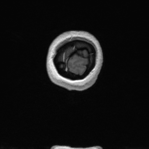Nasopharyngeal carcinoma (T1 N3a) with complete response (Radiopaedia 61357-69619 Coronal 3D volume 190).jpg