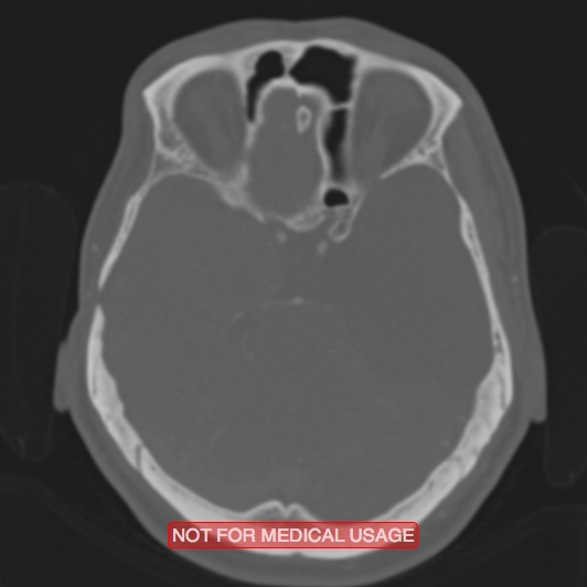 Nasopharyngeal carcinoma recurrence - skull base destruction (Radiopaedia 29107-29490 Axial bone window 69).jpg