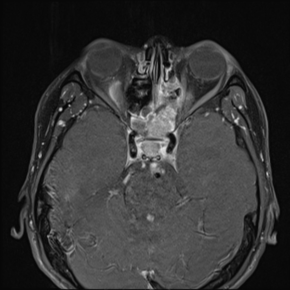 File:Nasopharyngeal carcinoma with skull base invasion (Radiopaedia 53415-59485 Axial T1 C+ fat sat 17).jpg