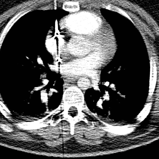 File:Neck CT angiogram (intraosseous vascular access) (Radiopaedia 55481-61945 Axial Monitoring 23).jpg