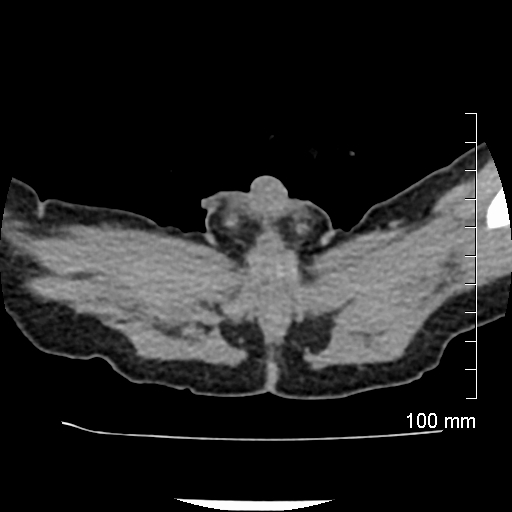 File:Neonatal neuroblastoma (Radiopaedia 56651-63438 Axial non-contrast 88).jpg