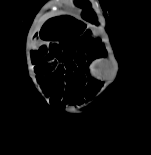 Nephroblastomatosis (Radiopaedia 71294-81607 B 50).jpg