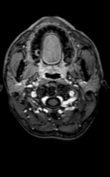 Neuro-Behçet disease (Radiopaedia 90112-107294 Axial T1 C+ 210).jpg