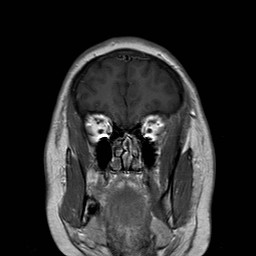 File:Neuro-Behcet's disease (Radiopaedia 21557-21505 Coronal T1 C+ 2).jpg
