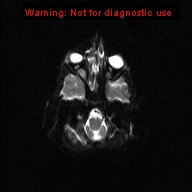 File:Neurofibromatosis type 1 with optic nerve glioma (Radiopaedia 16288-15965 Axial DWI 19).jpg