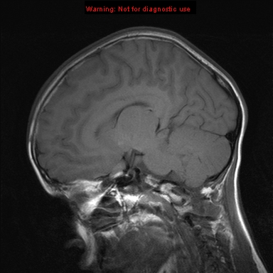File:Neurofibromatosis type 1 with optic nerve glioma (Radiopaedia 16288-15965 Sagittal T1 14).jpg