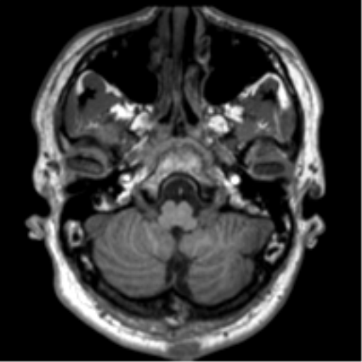 File:Neurofibromatosis type 2 (Radiopaedia 44936-48838 Axial T1 18).png