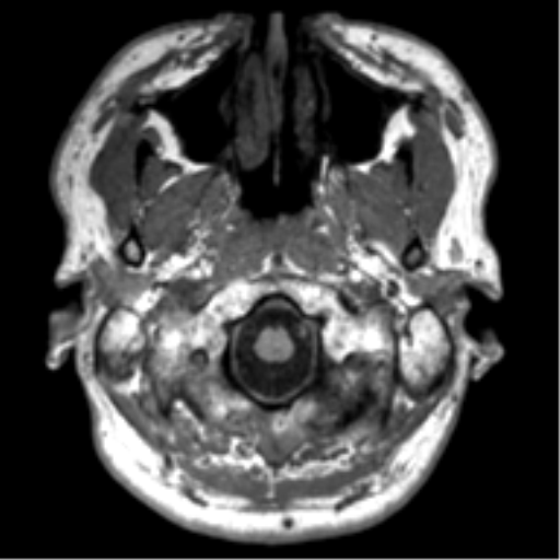 File:Neurofibromatosis type 2 (Radiopaedia 44936-48838 Axial T1 2).png