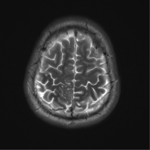 File:Neurofibromatosis type 2 (Radiopaedia 44936-48838 Axial T2 20).png