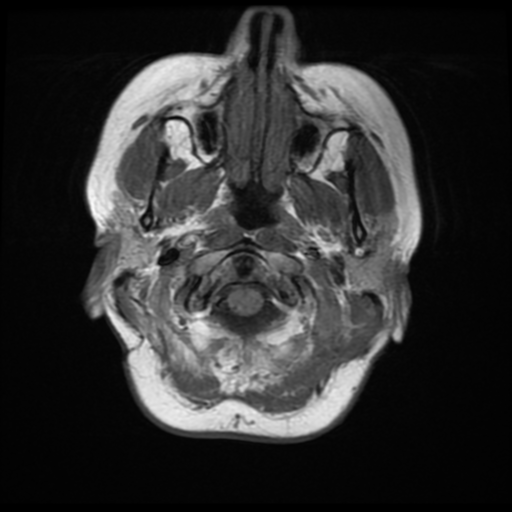 File:Neurofibromatosis type 2 (Radiopaedia 45229-49247 Axial T1 2).png