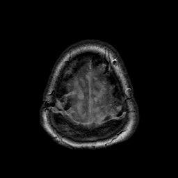File:Neurofibromatosis type 2 (Radiopaedia 8713-9518 Axial T1 2).jpg