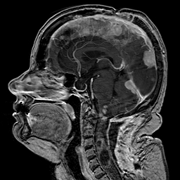 File:Neurofibromatosis type 2 (Radiopaedia 8713-9518 Sagittal T1 C+ 25).jpg