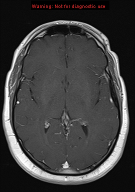 File:Neuroglial cyst (Radiopaedia 10713-11184 Axial T1 C+ 12).jpg