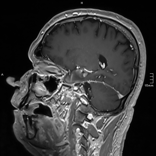 Neurosarcoidosis - involvement of the mesial temporal lobes (Radiopaedia 67429-76820 Sagittal T1 C+ 65).jpg