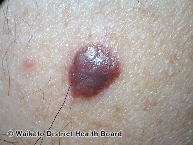 File:Nodular melanoma (DermNet NZ melanoma-abcds-27).jpg