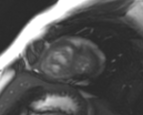 File:Non-compaction of the left ventricle (Radiopaedia 69436-79314 Short axis cine 46).jpg