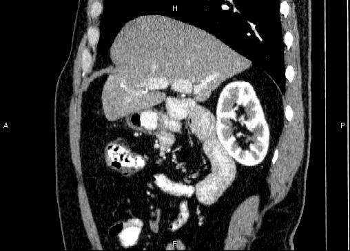 Non-syndromic pancreatic endocrine tumor (Radiopaedia 86958-103178 E 33).jpg
