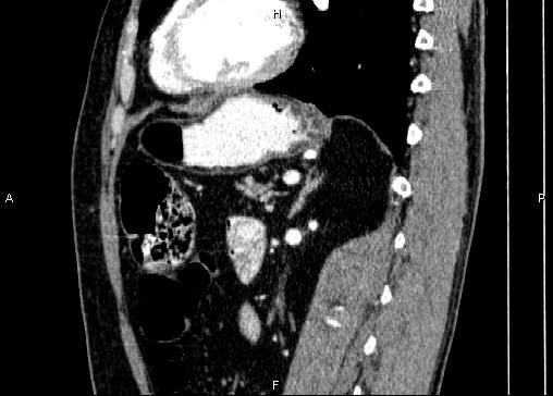 Non-syndromic pancreatic endocrine tumor (Radiopaedia 86958-103178 E 66).jpg