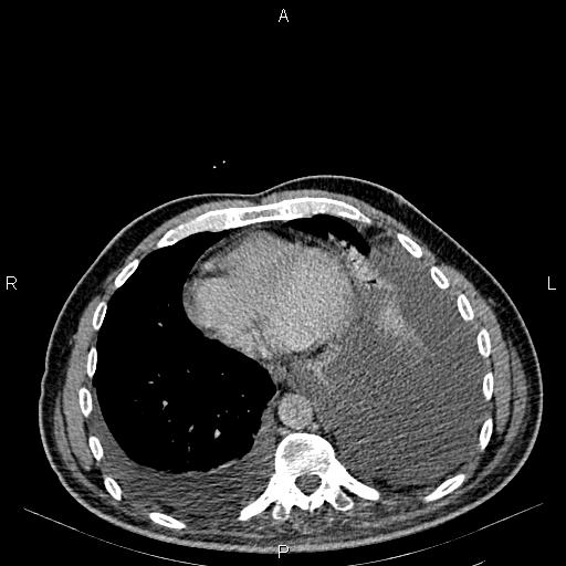Non Hodgkin lymphoma in a patient with ankylosing spondylitis (Radiopaedia 84323-99621 Axial C+ delayed 1).jpg