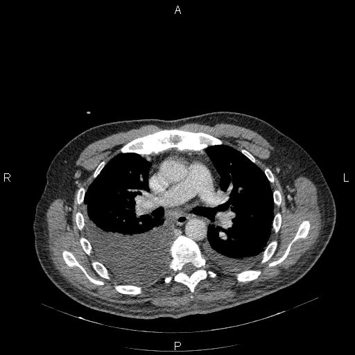 File:Non Hodgkin lymphoma in a patient with ankylosing spondylitis (Radiopaedia 84323-99624 B 13).jpg