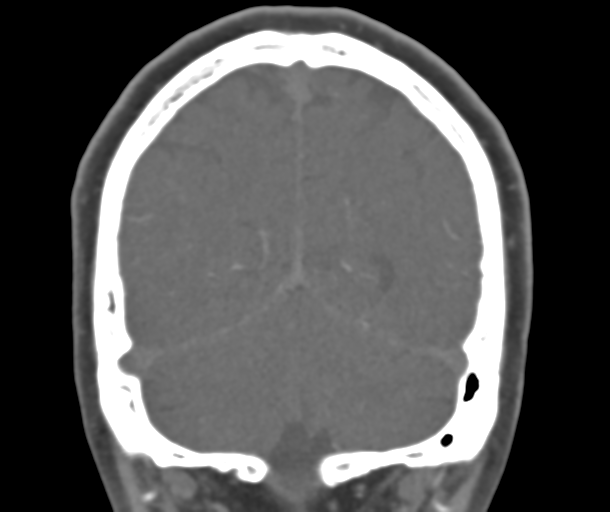 File:Normal CTA head (Radiopaedia 40801-43464 B 74).png