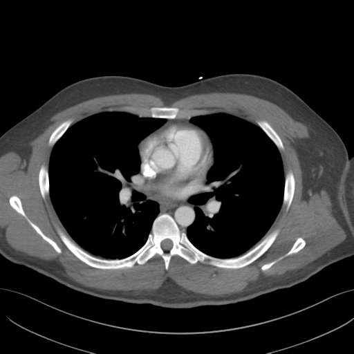 File:Normal CTA thorax (non ECG gated) (Radiopaedia 41750-44704 A 47).png