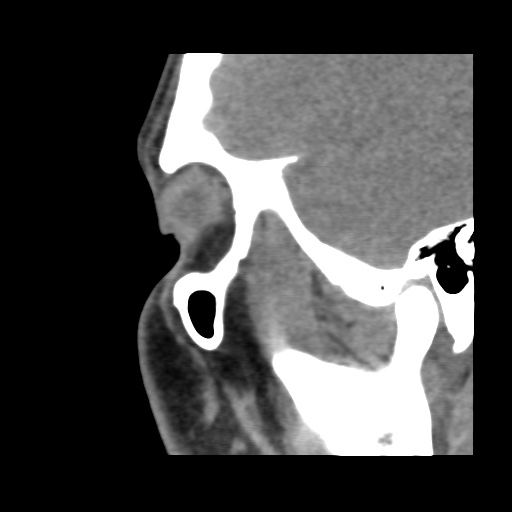 Normal CT paranasal sinuses (Radiopaedia 42286-45390 F 35).jpg