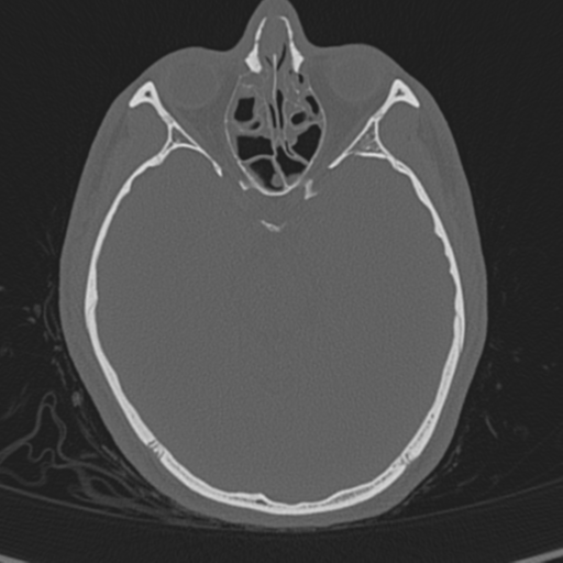 Normal CT skull (Radiopaedia 40798-43459 A 60).png