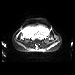 Normal MRI abdomen in pregnancy (Radiopaedia 88001-104541 Axial DWI 15).jpg