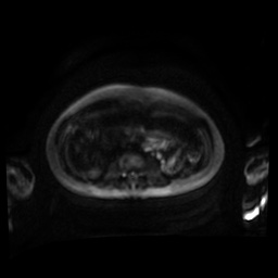 Normal MRI abdomen in pregnancy (Radiopaedia 88001-104541 Axial DWI 69).jpg