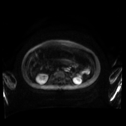 Normal MRI abdomen in pregnancy (Radiopaedia 88001-104541 Axial DWI 72).jpg