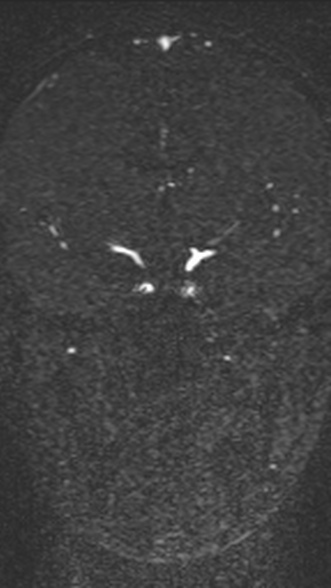 Normal MRI brain with MRV- teenager (Radiopaedia 49425-54553 Coronal MRV 116).jpg