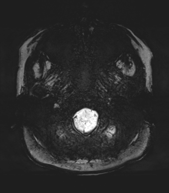 Normal MRI internal auditory canal (Radiopaedia 41613-44525 Axial SWI MIP 5).png