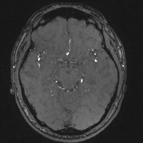 Normal brain MRI including MRA (Radiopaedia 48748-53763 Axial MRA 90).jpg