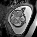 File:Normal brain fetal MRI - 22 weeks (Radiopaedia 50623-56050 Axial T2 Haste 9).jpg