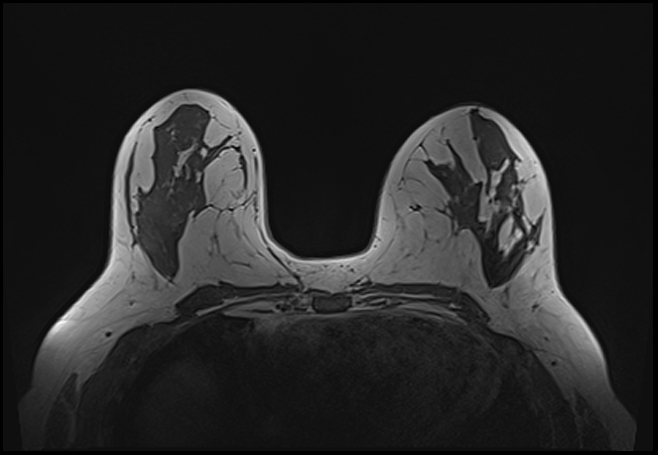 File:Normal breast MRI - dense breasts (Radiopaedia 80454-93850 Axial T1 108).jpg