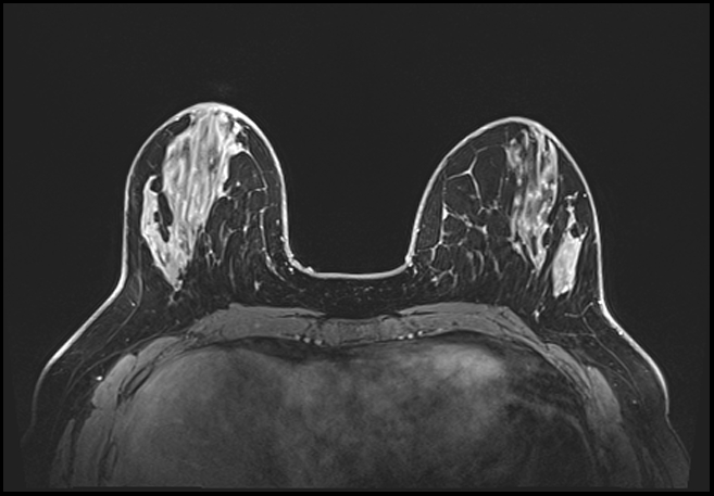 Normal breast MRI - dense breasts (Radiopaedia 80454-93850 C 78).jpg
