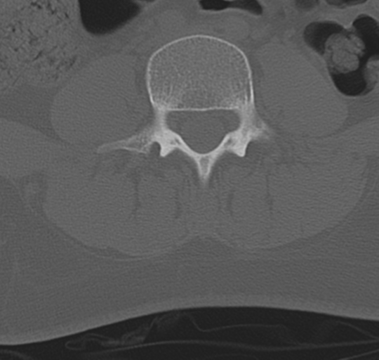 File:Normal lumbosacral CT (Radiopaedia 37923-39867 Axial bone window 63).png