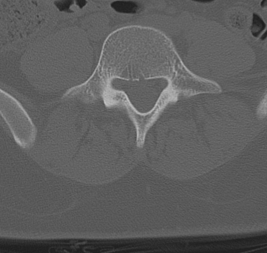File:Normal lumbosacral CT (Radiopaedia 37923-39867 Axial bone window 73).png