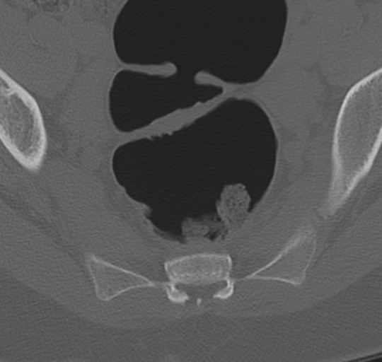 File:Normal lumbosacral CT (Radiopaedia 37923-39867 Axial bone window 98).png