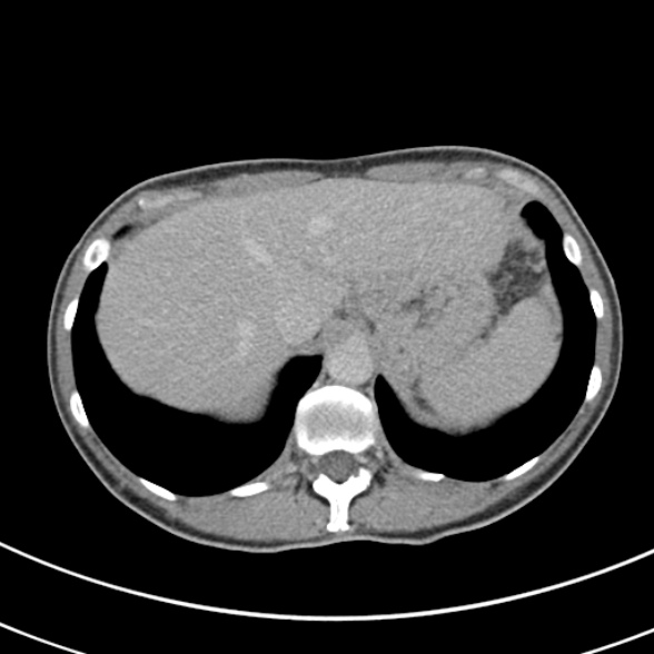 File:Normal multiphase CT liver (Radiopaedia 38026-39996 Axial C+ delayed 12).jpg