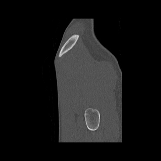 Normal pelvis (Radiopaedia 51473-57238 Sagittal bone window 141).jpg